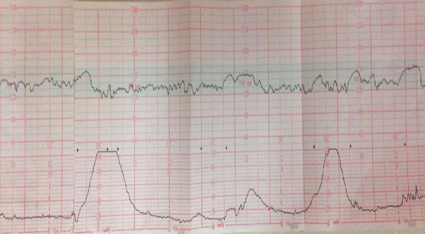 病例21 羊水污染